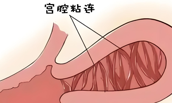 宫腔粘连怎么办?宫腔黏连治疗手术危险吗?